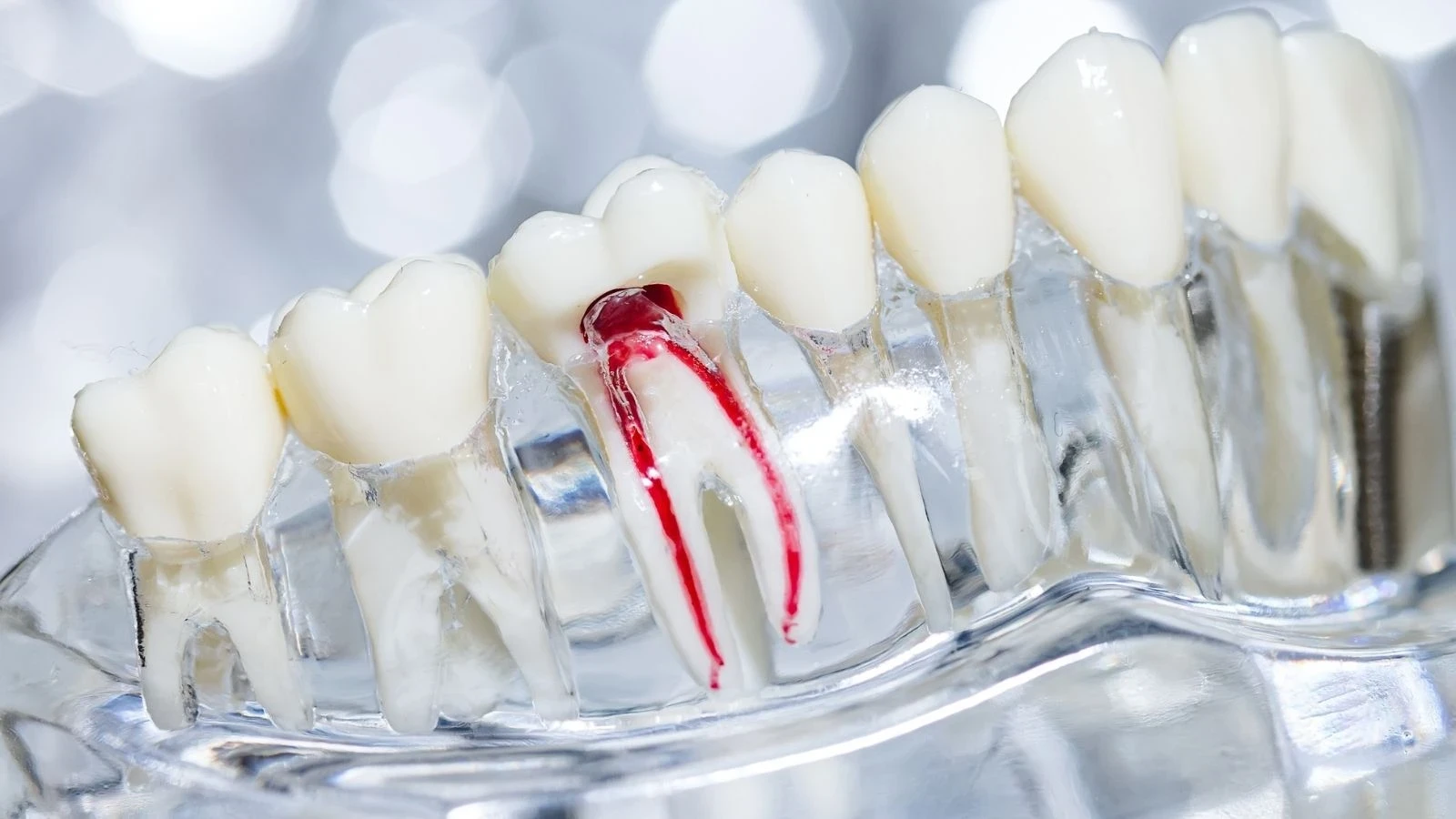 Kanal Tedavisi (Endodonti)